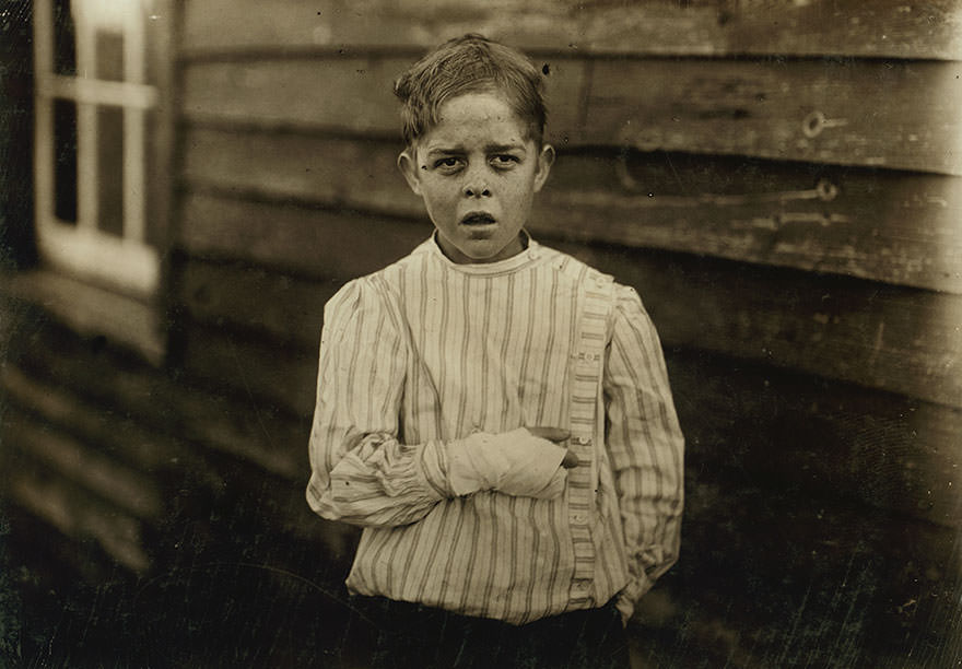 #6 Accident to young mill worker. Giles Edmund Newsome. While working in sanders spinning mile, a piece of the machine fell on to his foot mashing his toe. This caused him to fall on to a spinning machine and his hand went into unprotected gearing, crushing and tearing out two fingers. He told the atto