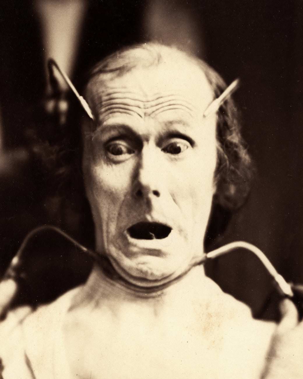 A patient undergoing experimental electrical stimulation in 1856
