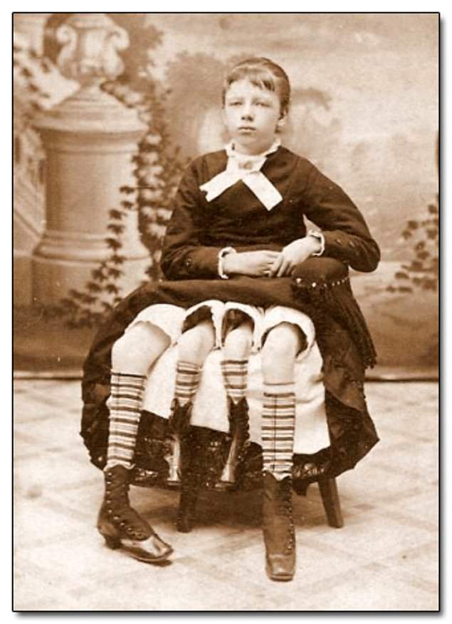 Myrtle Corbin, who was born in 1868 as a dipygus, which is a medical term for having an extra pelvis