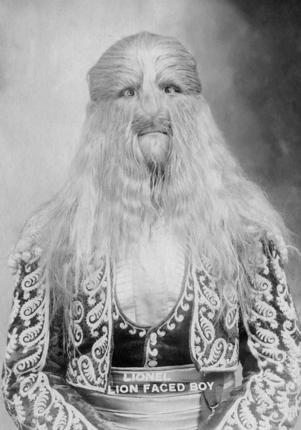 A portrait of “Lionel the Lion Faced Boy” during the height of his fame in 1907