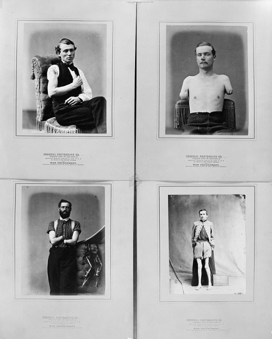 #14 This series of photographs, compiled by the U.S. Surgeon General’s Office, illustrates the different types of arm amputations.