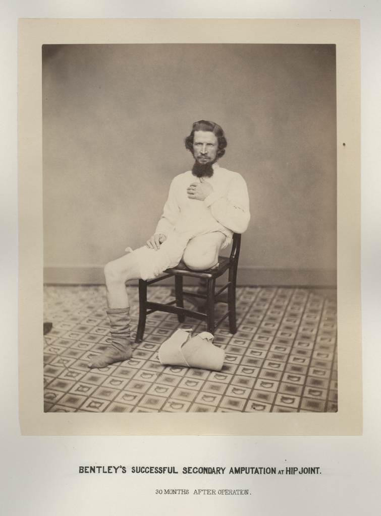 #15 Private George W. Lemon, from George A. Otis, Drawings, Photographs and Lithographs Illustrating the Histories of Seven Survivors of the Operation of Amputation at the Hipjoint, During the War of the Rebellion, Together with Abstracts of these Seven Successful Cases, 1867