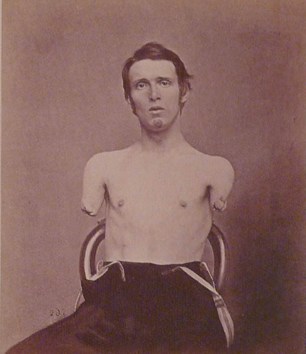 #23 On June 18, 1864, a cannon shot took both arms of Alfred Stratton. He was just 19 years old.