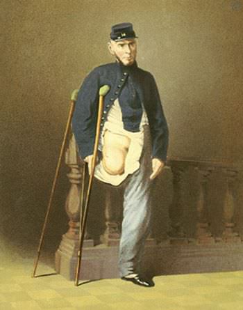 #25 Private Lewis Francis, Co. I, 14th New York Militia, was wounded July 21, 1861, at the first battle of Bull Run by a bayonet to the knee. He was stabbed at least 14 more times. He died May 31, 1874.