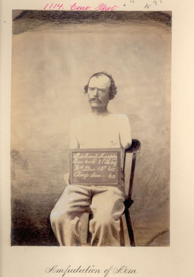 #27 Pennsylvania infantryman Richard Murphy was wounded in December 1862. Surgeons amputated his arm shortly thereafter.