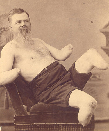 #29 A man who lost all of his limbs during a battle but he still managed to look cheeky for the camera.