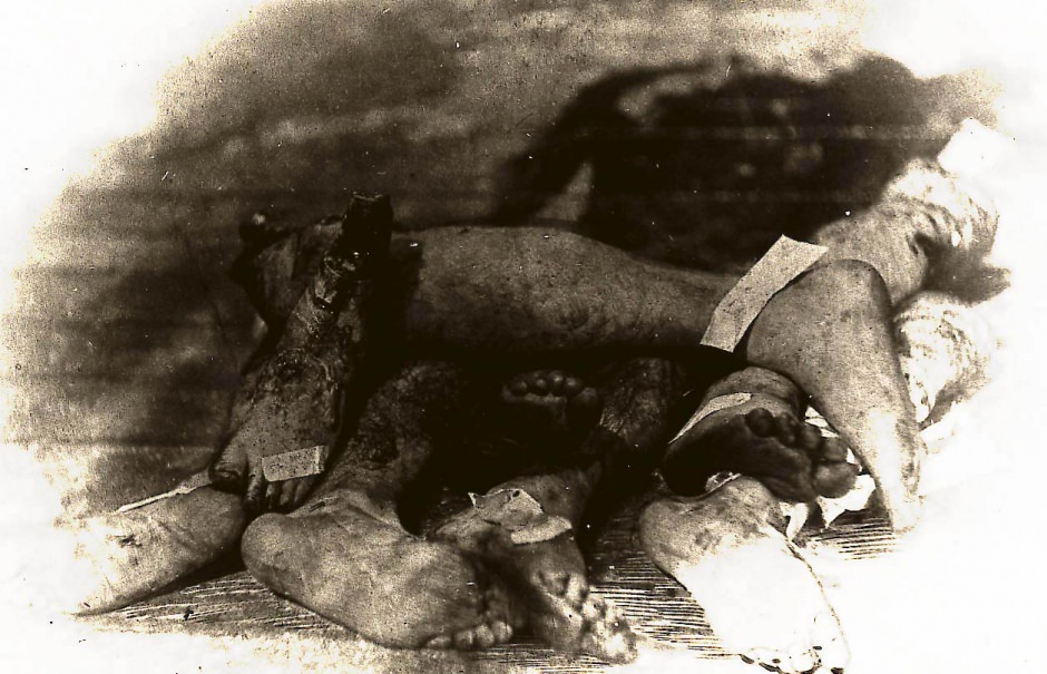 #31 Pile of severed, amputated arms and legs in an undated photo.