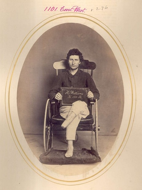 #32 Hiram Williams. Amputation of leg and foot, shell wound. PVT, Company K, 98th Pennsylvania Volunteers. Injured at the 1865 Battle of Appomattox