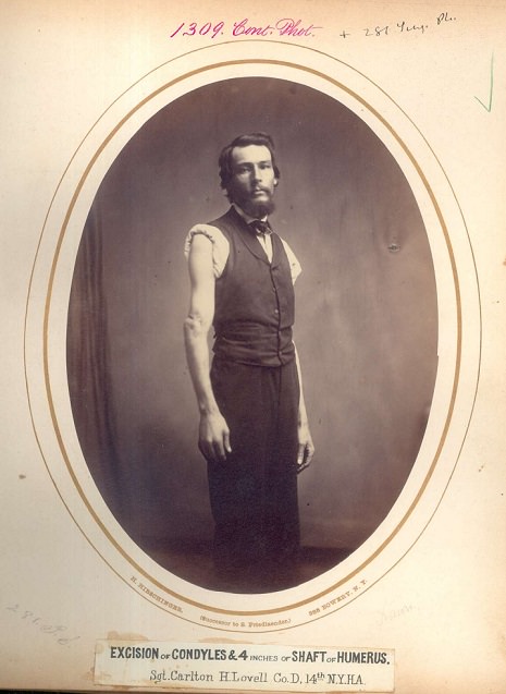#33 Sgt. Carlton H. Lovell, 14th New York Heavy Artillery. Wounded June 2, 1864 at the Battle of Cold Harbor, Virginia.