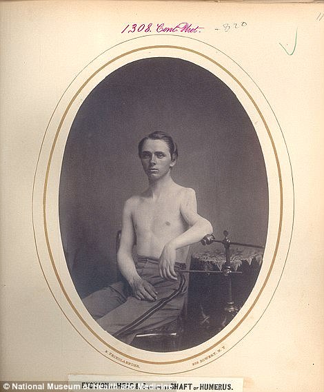 #35 Sergeant Hector Sears from the Ohio Volunteers, was another to have six inches of his humerus removed