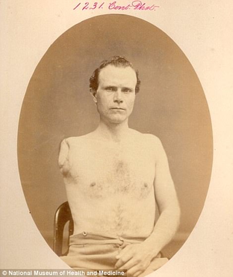 #37 Samuel Irwin, of the 67th Pennsylvania Volunteers, had his right arm cut off at the shoulder joint