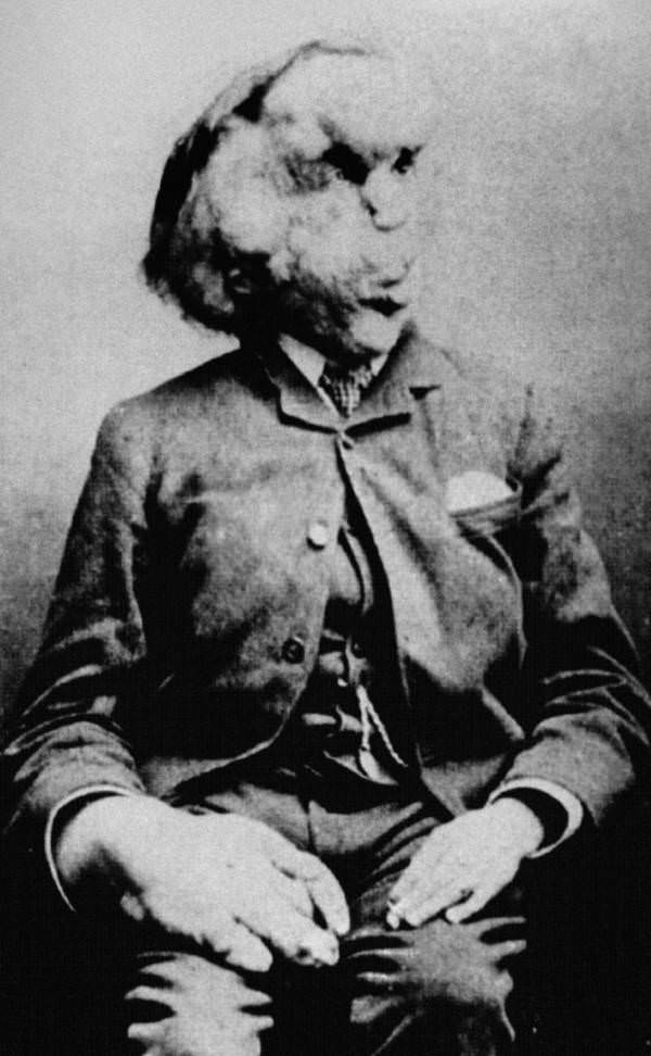 Joseph Merrick, England’s famous Elephant Man, 1880s