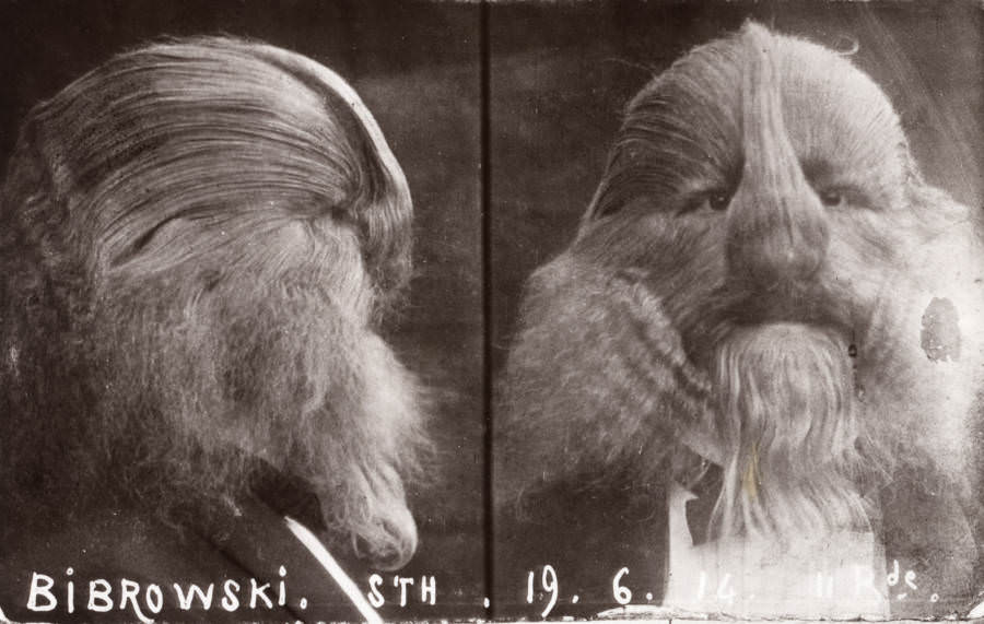 Stephan Bibrowski, better known as Lionel the “Lion-faced Man.”, 1914