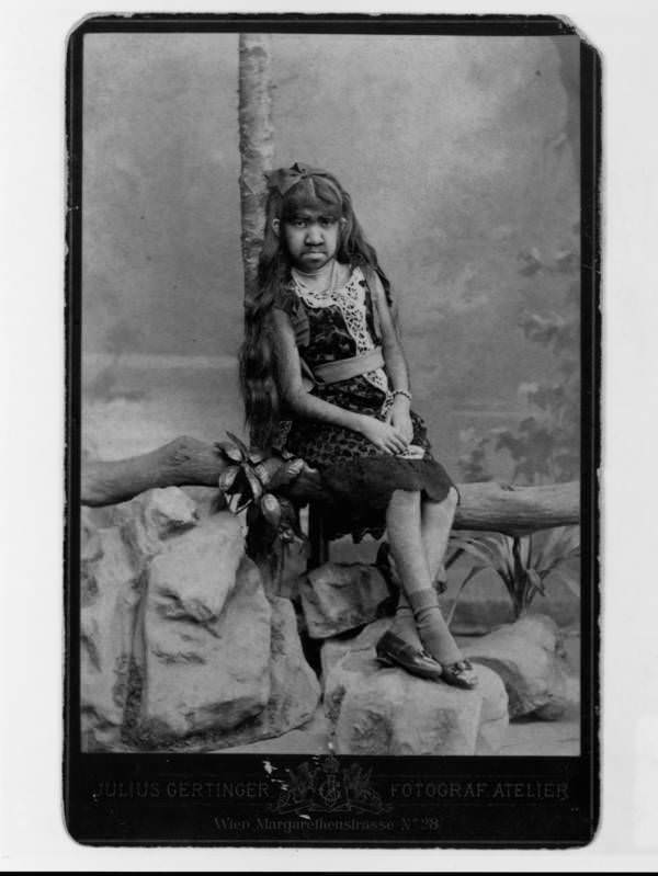 Krao Farini was a hairy, flexibly-jointed woman found in the Laotian jungle in 1885 and put on display by P.T. Barnum as a “Missing Link.” 1889