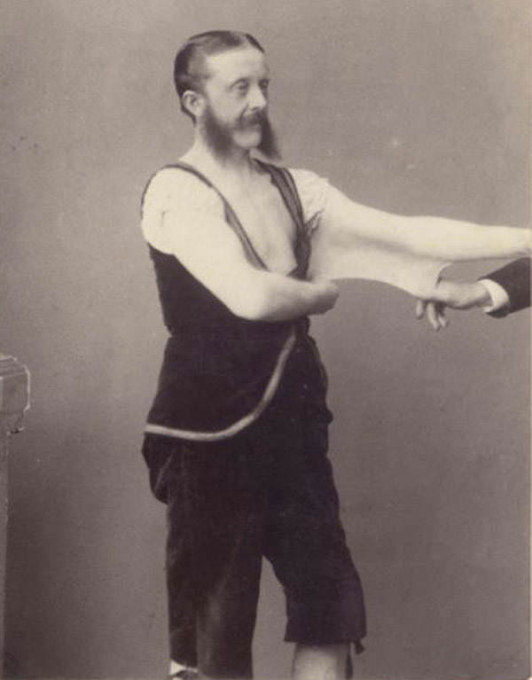 Ehlers-Danlos Syndrome allowed Felix Wehrle to stretch his skin to great length and take on the name “Elastic Man.”