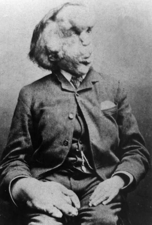 Better known as the “elephant man,” Joseph Merrick lived a tragic life. Rejected by his parents, he was left to join a touring freak show act, 1889