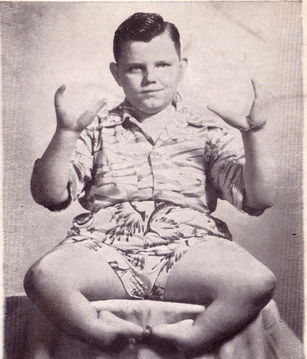 Grady Stiles Jr. a.k.a. “Lobster Boy” came from a long line of family members who suffered from the same birth defect that lent him his stage name.
