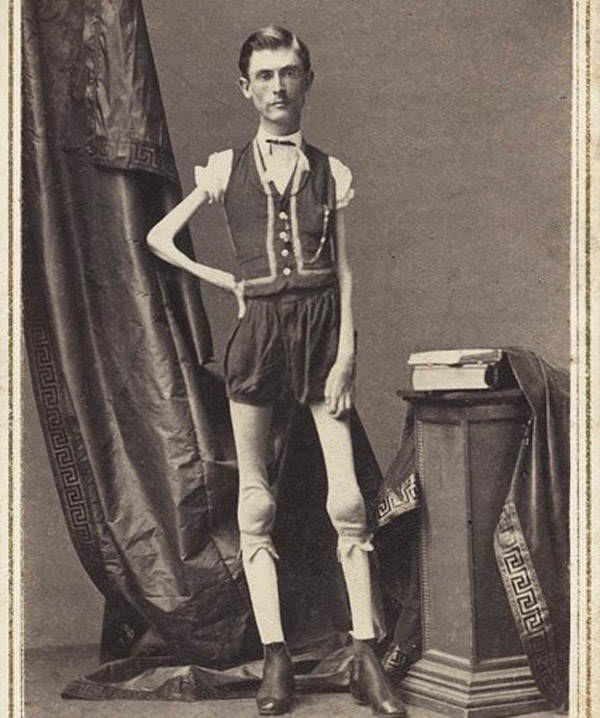 Billed as the “Living Human Skeleton,” Isaac Sprague began irreversibly losing weight at age 12 for reasons that remain unclear, 1866