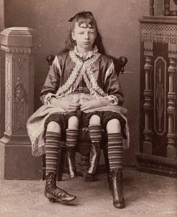 Dubbed the “Four-Legged Girl From Texas,” Myrtle Corbin was born with a severe congenital deformity that caused her to have two separate pelvises and a smaller set of legs, 1882
