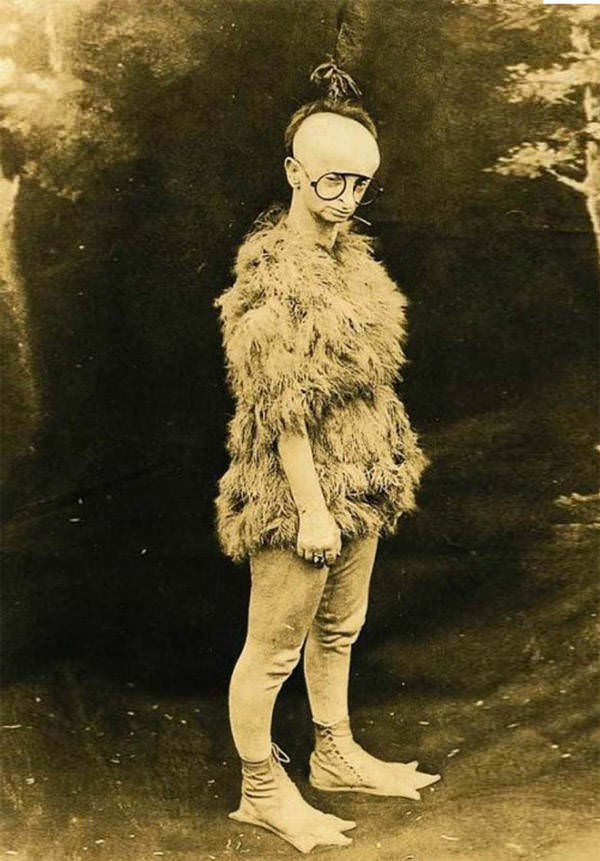 Minnie Woolsey, known as “Koo-Koo the Bird Girl,” suffered from Seckel syndrome, giving her both physical and mental disabilities.
