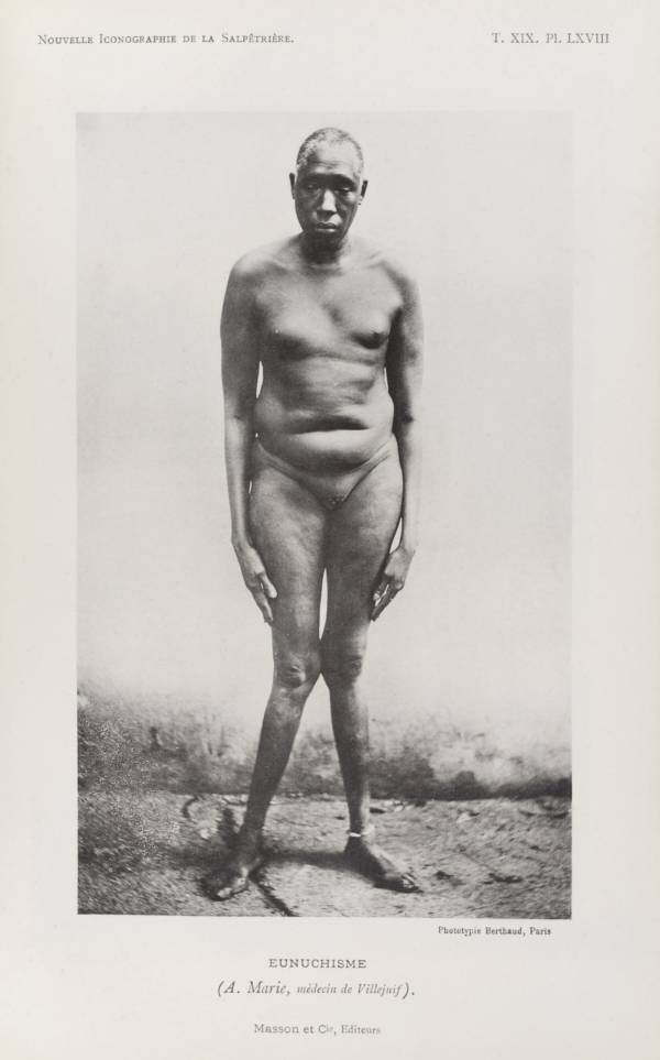 A humiliated-looking man with “eunuchism” allows scientists of the Eugenics Society to photograph him in the nude