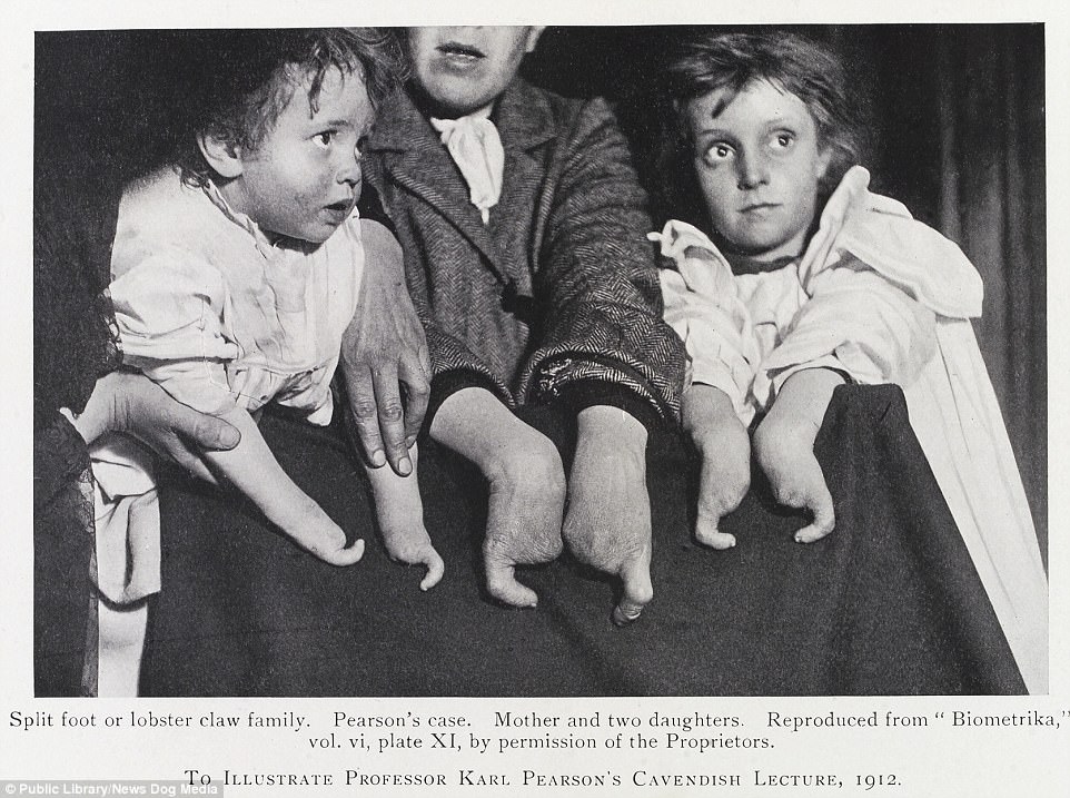 A photograph from the Eugenics Society showing a family with the “lobster claw” deformity, meant as a demonstration of a hereditary defect, 1912.