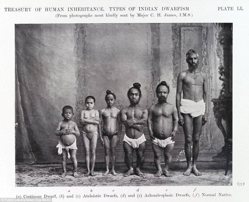 Photographs of ‘Indian Dwarfism’ from the Eugenics Society in 1912.