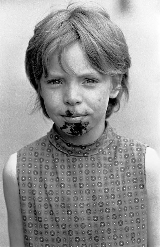 #17 Child with Impetigo caused by foul drainage, Winson Green 1971