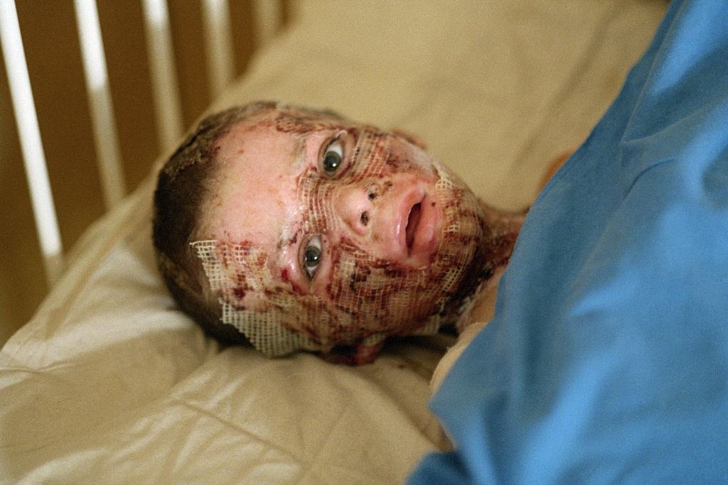 Four-year-old Jasmin Hreljic is being treated at Sarajevo’s children’s hospital for burns suffered to his face when a kerosene lamp exploded.