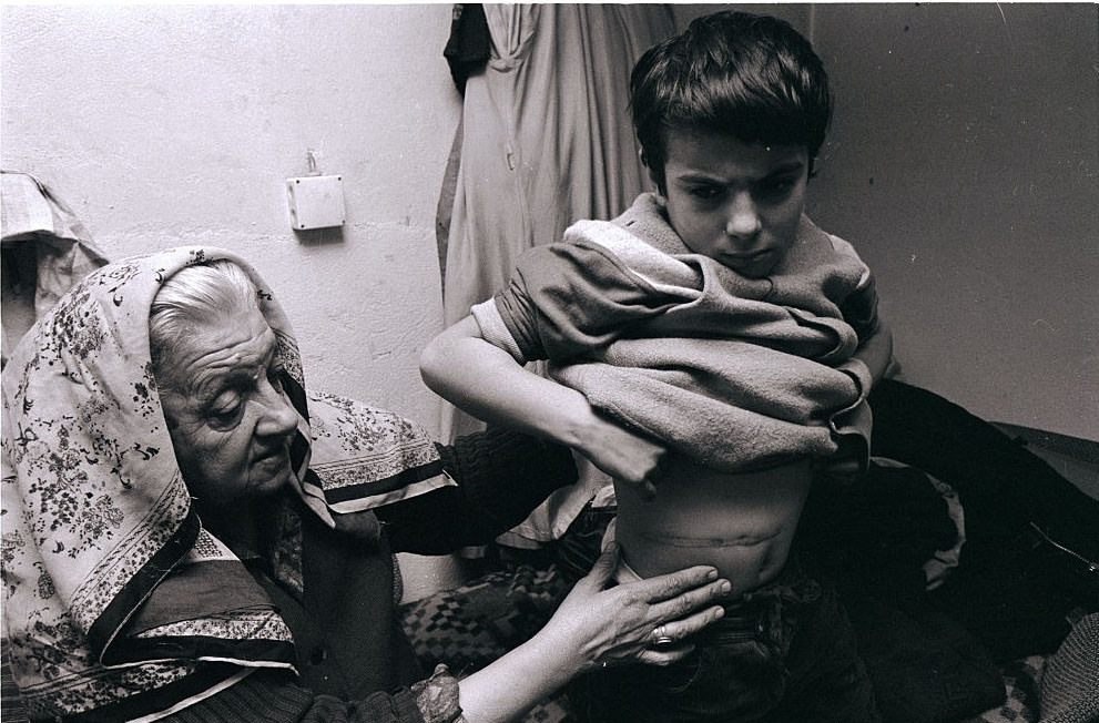 Mirza Mangajic, a 10-year-old Muslim boy, survives in Sarajevo’s Old Town quarter with his grandmother, showing a scar on his belly he received from a grenade explosion.