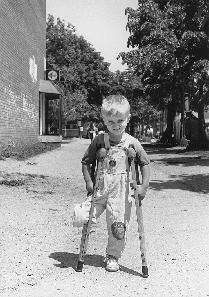Child victims of war – Aladdin, 4, Muslim, lost a leg during the siege of the Bihac enclave on January 9, 1994.