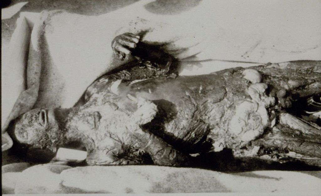 #11 A burnt body of a victim of Bosnian Genocide, 1992.