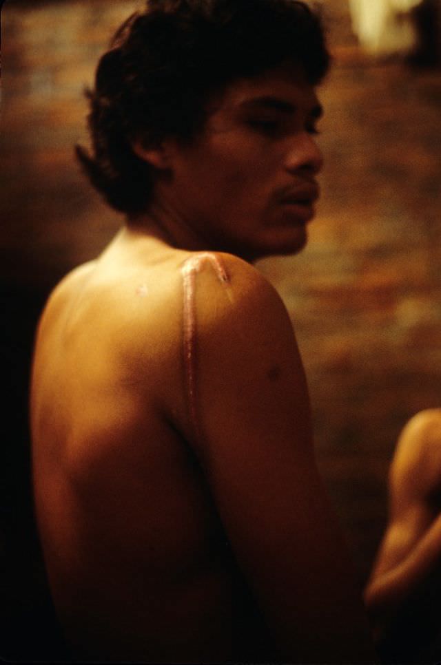 #4 This prisoner had battery acid poured on his shoulder by Somoza’s National Guard, Managua, 1978
