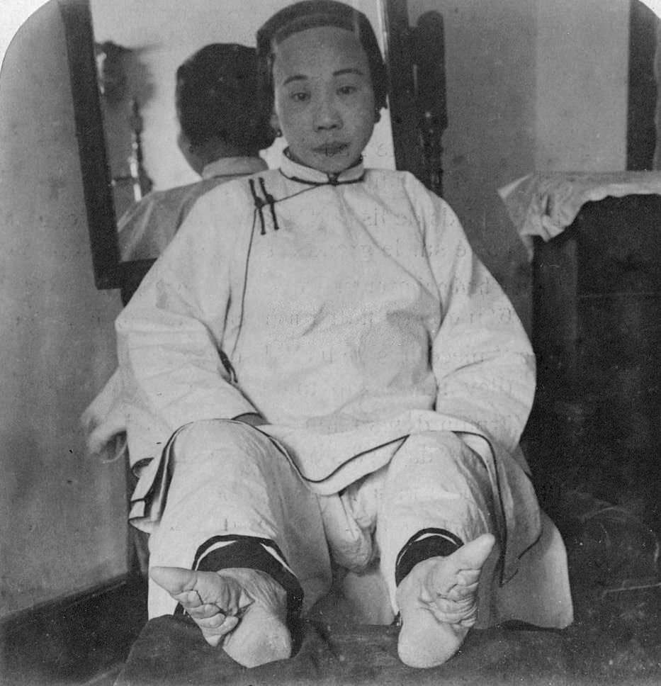 A high caste lady’s dainty ‘lily feet’, showing method of deformity’, China, 1900.