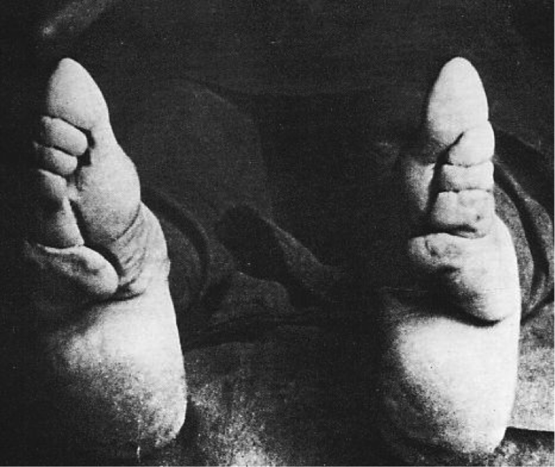 Bound Feet: Horrible Body Modification that Chinese Women Practiced for One Thousand years Weird