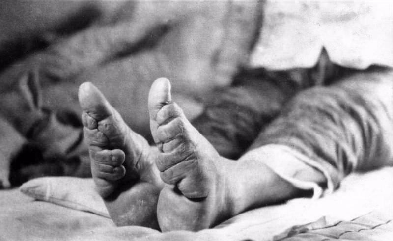 Bound Feet: Horrible Body Modification that Chinese Women Practiced for One Thousand years Weird