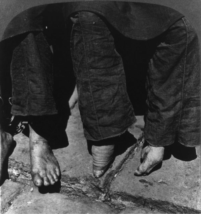 Bound Feet: Horrible Body Modification that Chinese Women Practiced for One Thousand years Weird