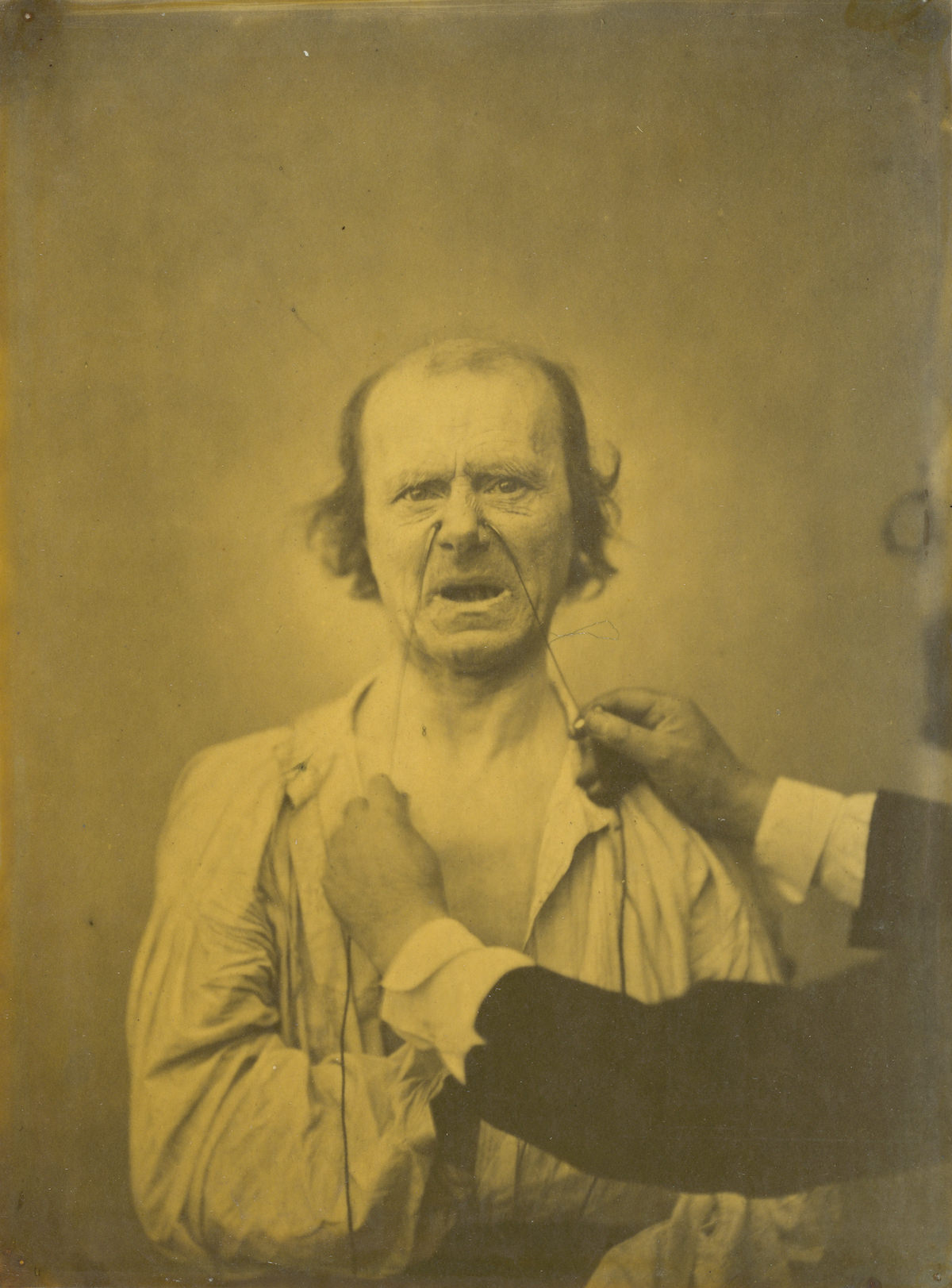 #15 Guillaume-Benjamin-Amant Duchenne (de Boulogne), Discontent, bad humor, 1854-1856