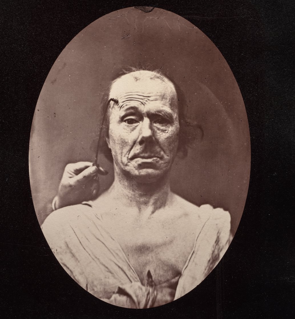 #2  Stunning Illustrations from the Mechanism of Human Physiognomy by Guillaume-Benjamin-Amand Duchenne de Boulogne