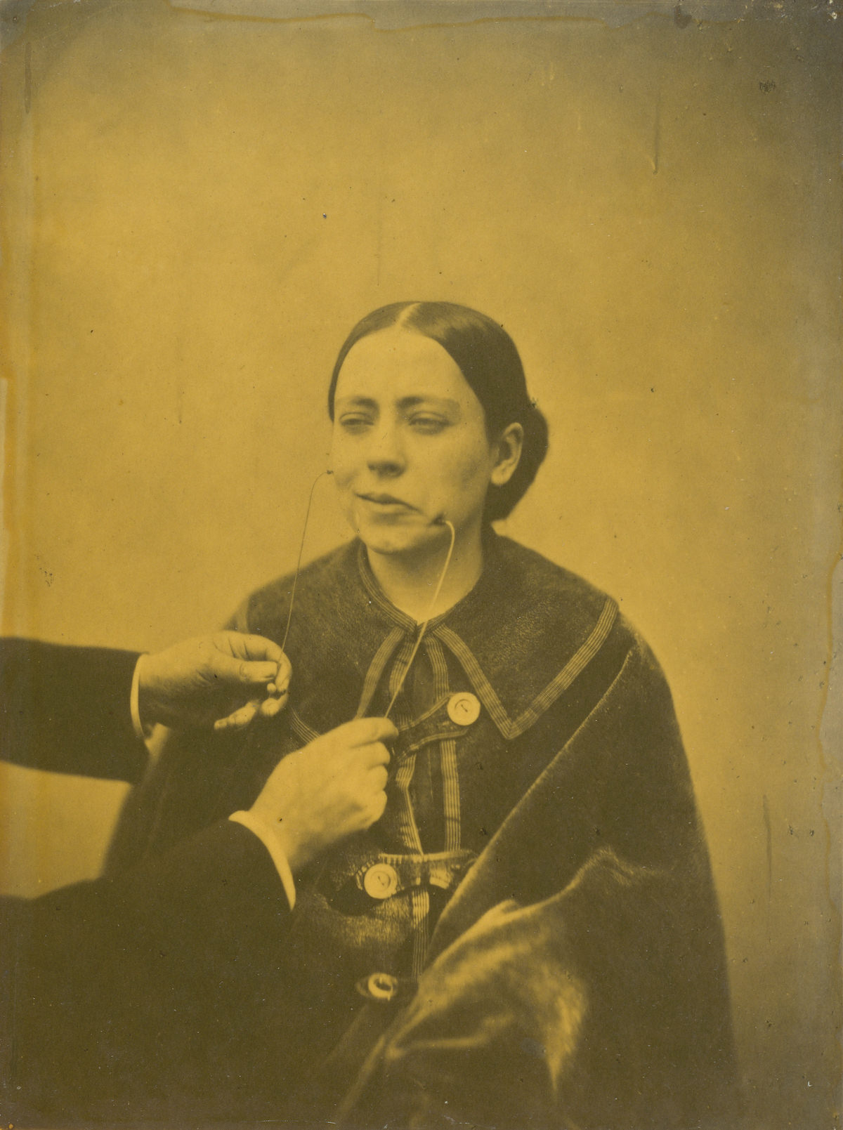 #28 Figure 50: Affected weeping and face in repose