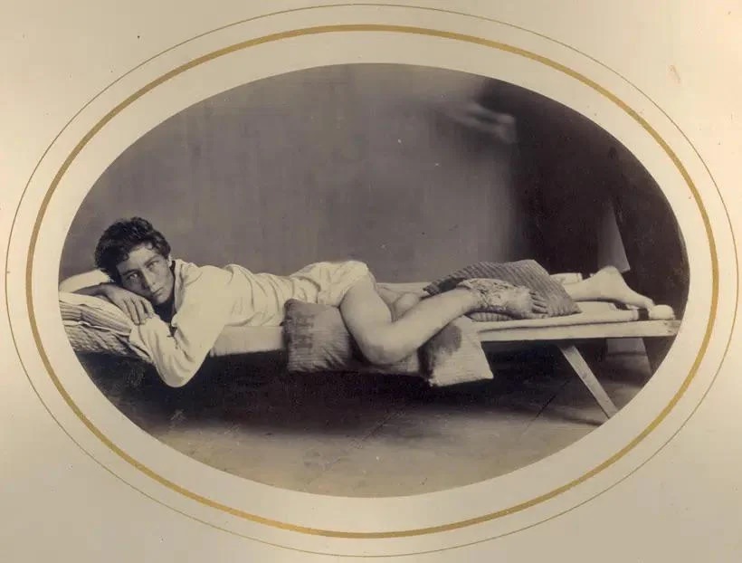 #51 Surviving Limb Loss: The Stories of Civil War Amputee Veterans #51 Civil Wars