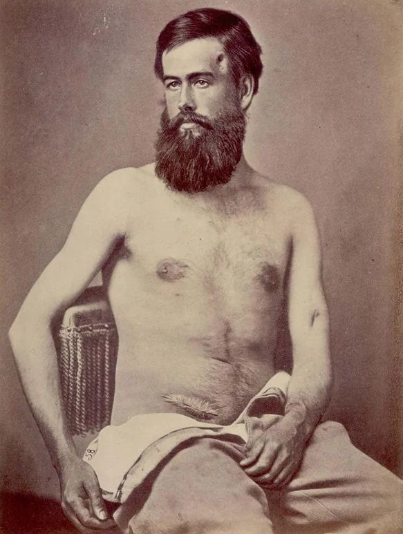 #56 Private Edson D. Bemis, K, 12th Massachusetts, was wounded at Antietam by a musket ball, which fractured the shaft of his left humerus.
