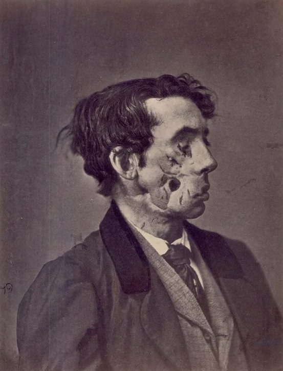 #62 Private Joseph Harvey, C, 149th New York, was wounded at the battle of Chancellorsville, May 3, 1863, by a fragment of shell.