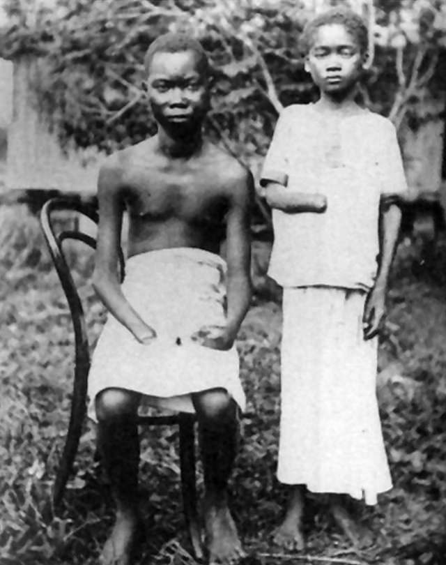 The Belgian Congo’s Hacked Hands: A Brutal Reminder of Colonial Atrocities Weird