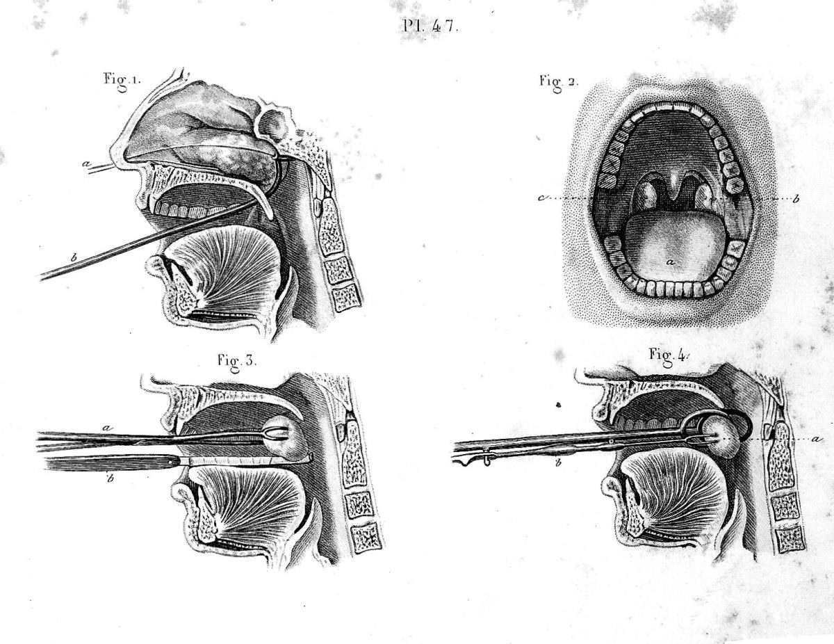 19th Century Illustrations for the Surgical Removal of Unwanted Parts of the Human Body Artworks