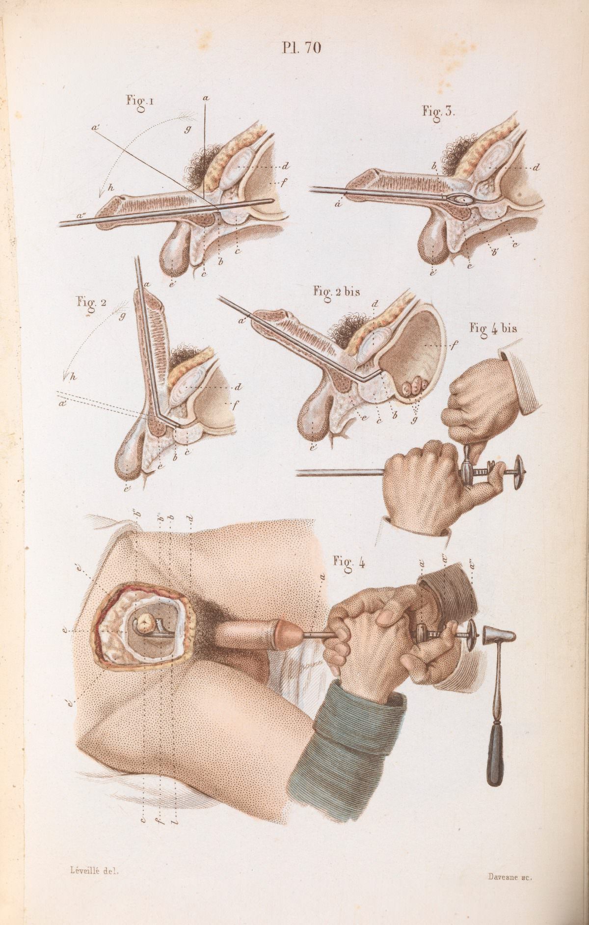 Plate 70, Surgical techniques for lithotripsy (the removal of bladder and kidney stones). Précis iconographique de médecine opératoire et d’anatomie chirurgicale by Claude Bernard (1848).