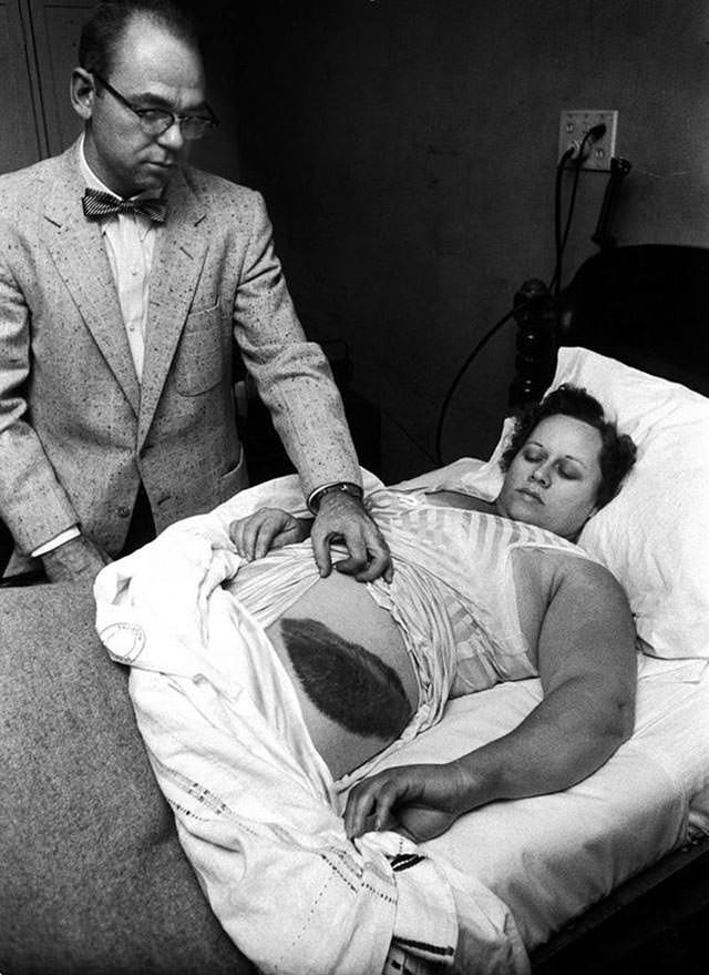Doctor Moody Jacobs shows a giant bruise on the side his patient, Ann Hodges, the only person in history to have been struck by a meteorite, 1954.